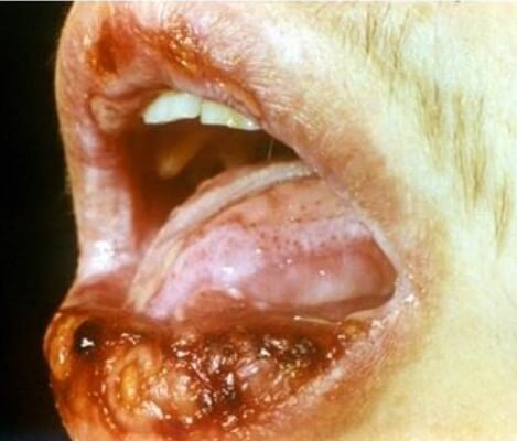 выраженная эритема слизистой оболочки рта